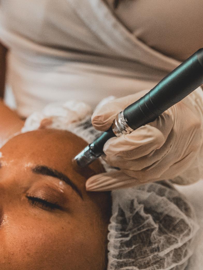 5 zaken je u moet weten over microneedling