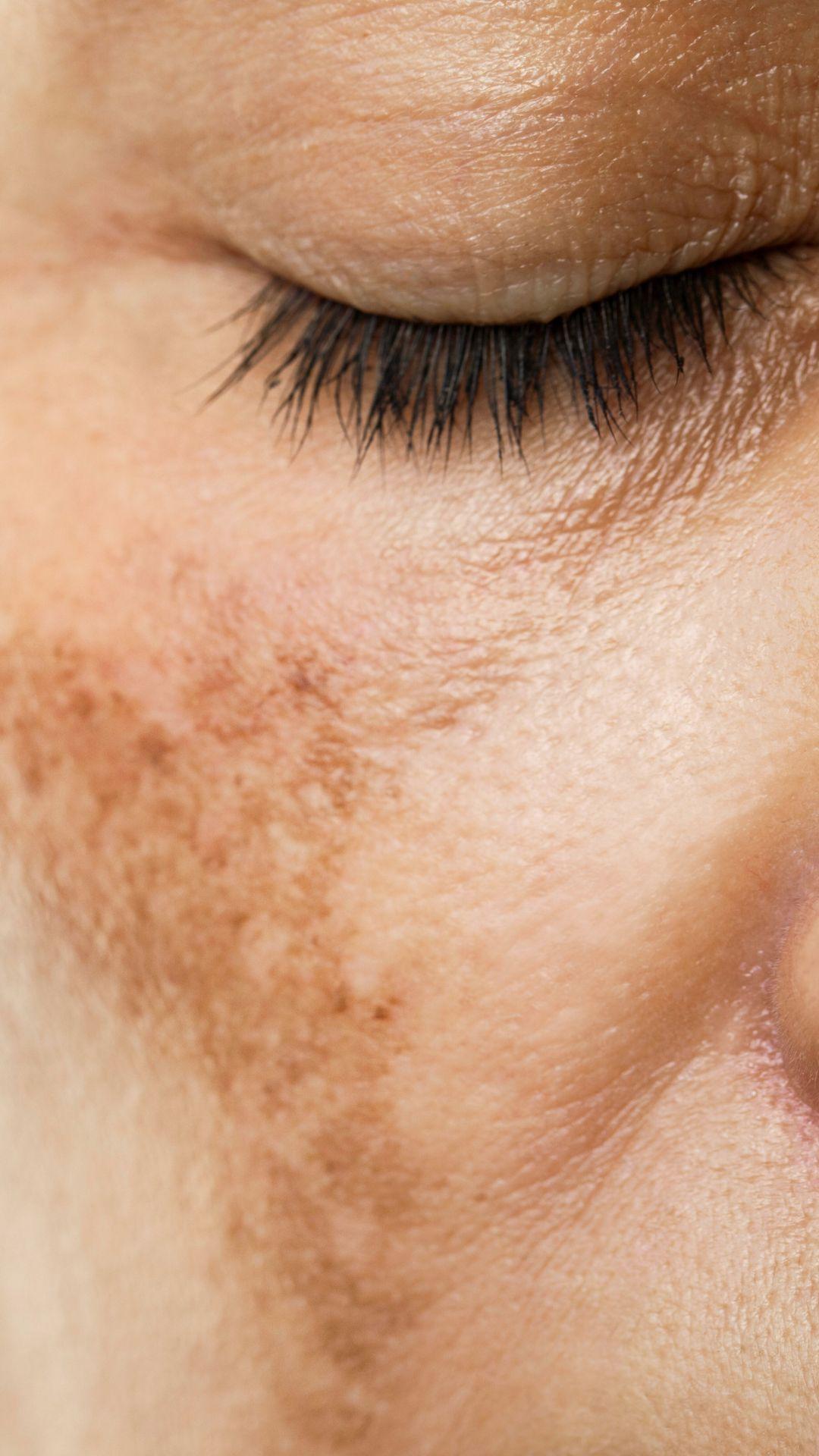recente studies melasma online beauty opleiding gratis opleiding