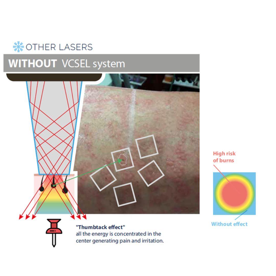 Diodelaser zonder VCSEL systeem